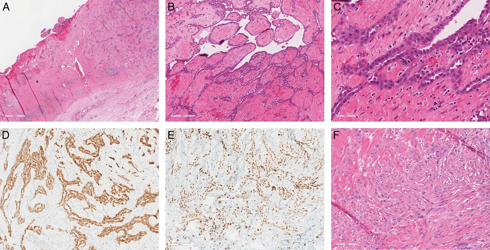 病理医师反间计之心包间皮瘤(一)