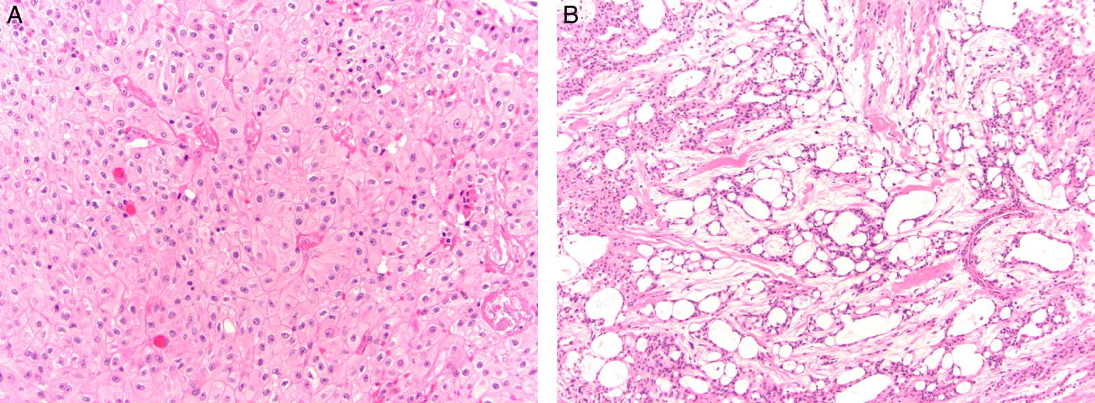 病理医师反间计之心包间皮瘤(一)