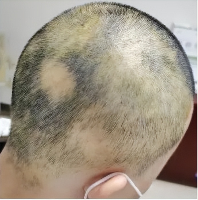 许女士,从去年8月份,他头上有几块地方的头皮光秃秃的,没了头发