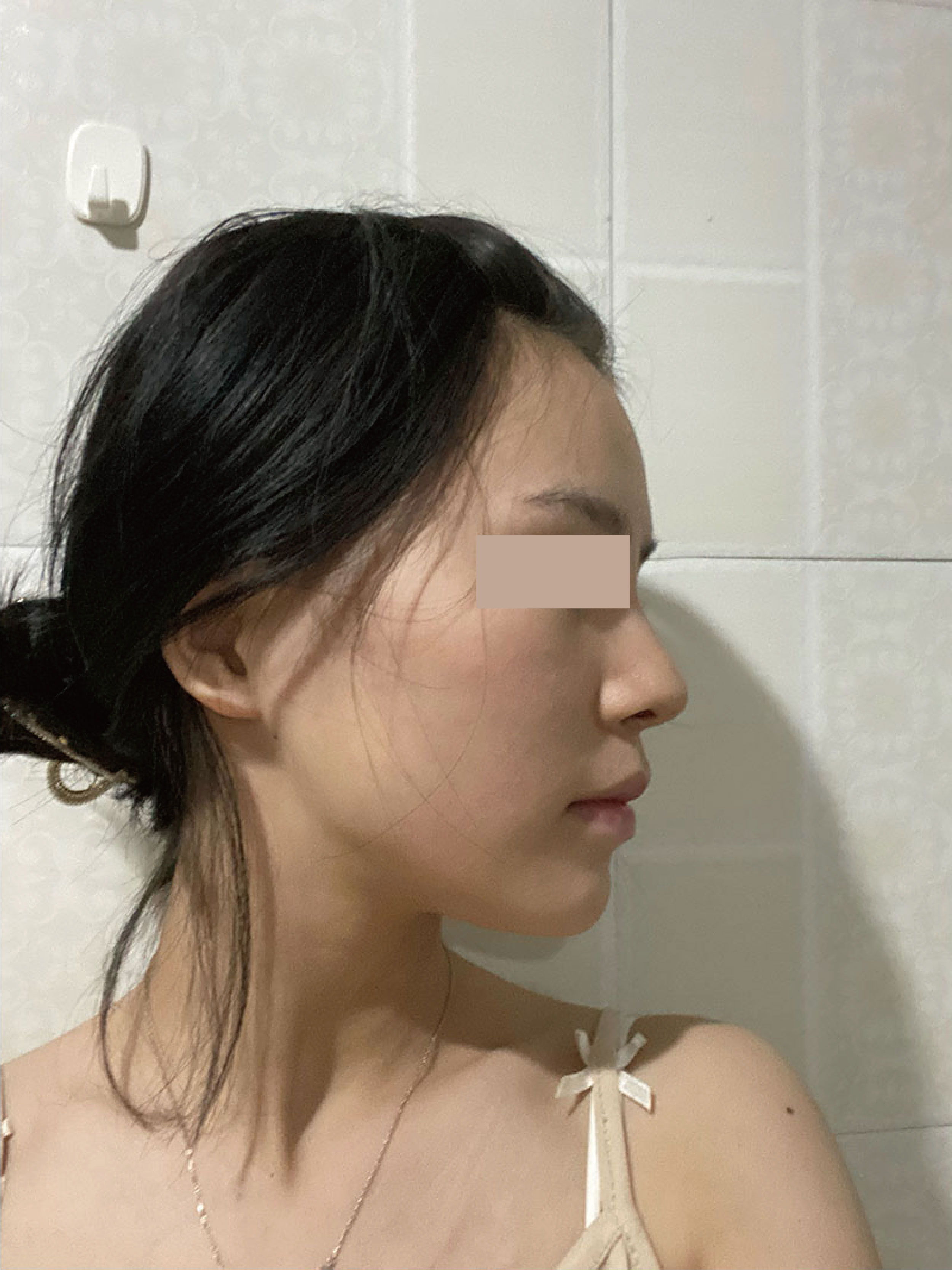 30岁颧骨颧弓很突出比同龄人都显老