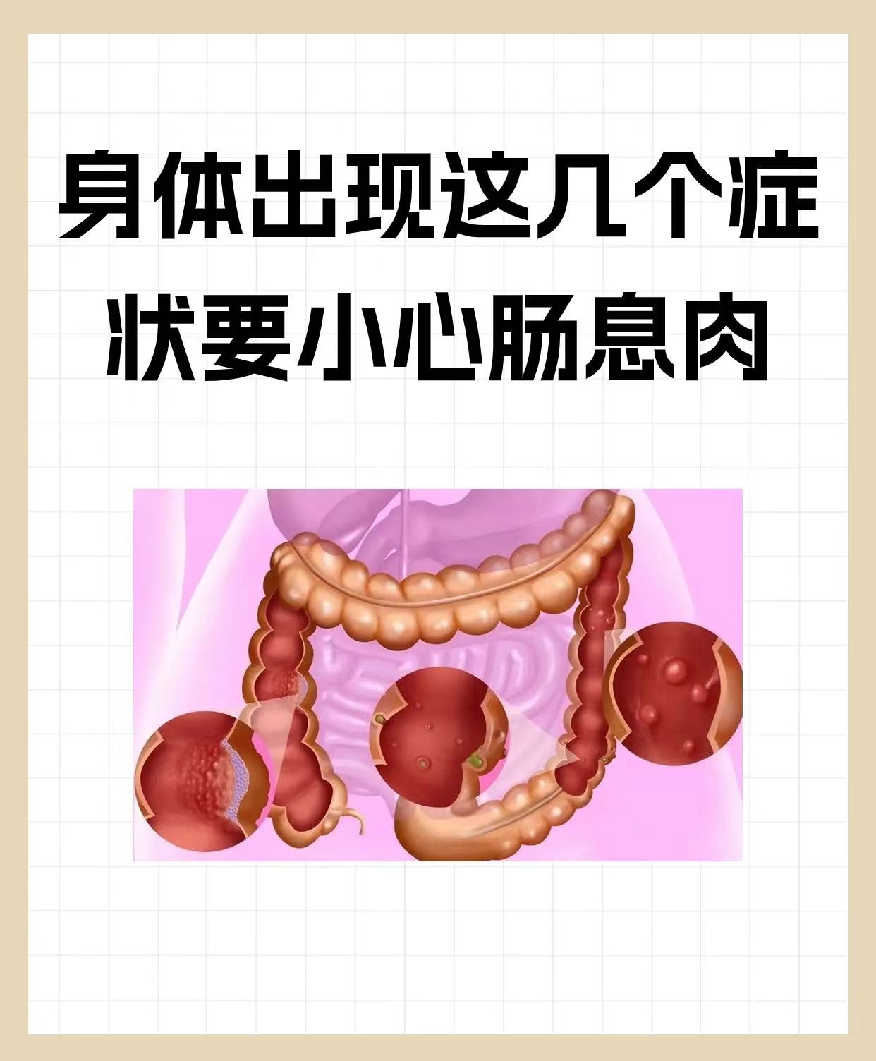 直肠息肉症状 早期图片