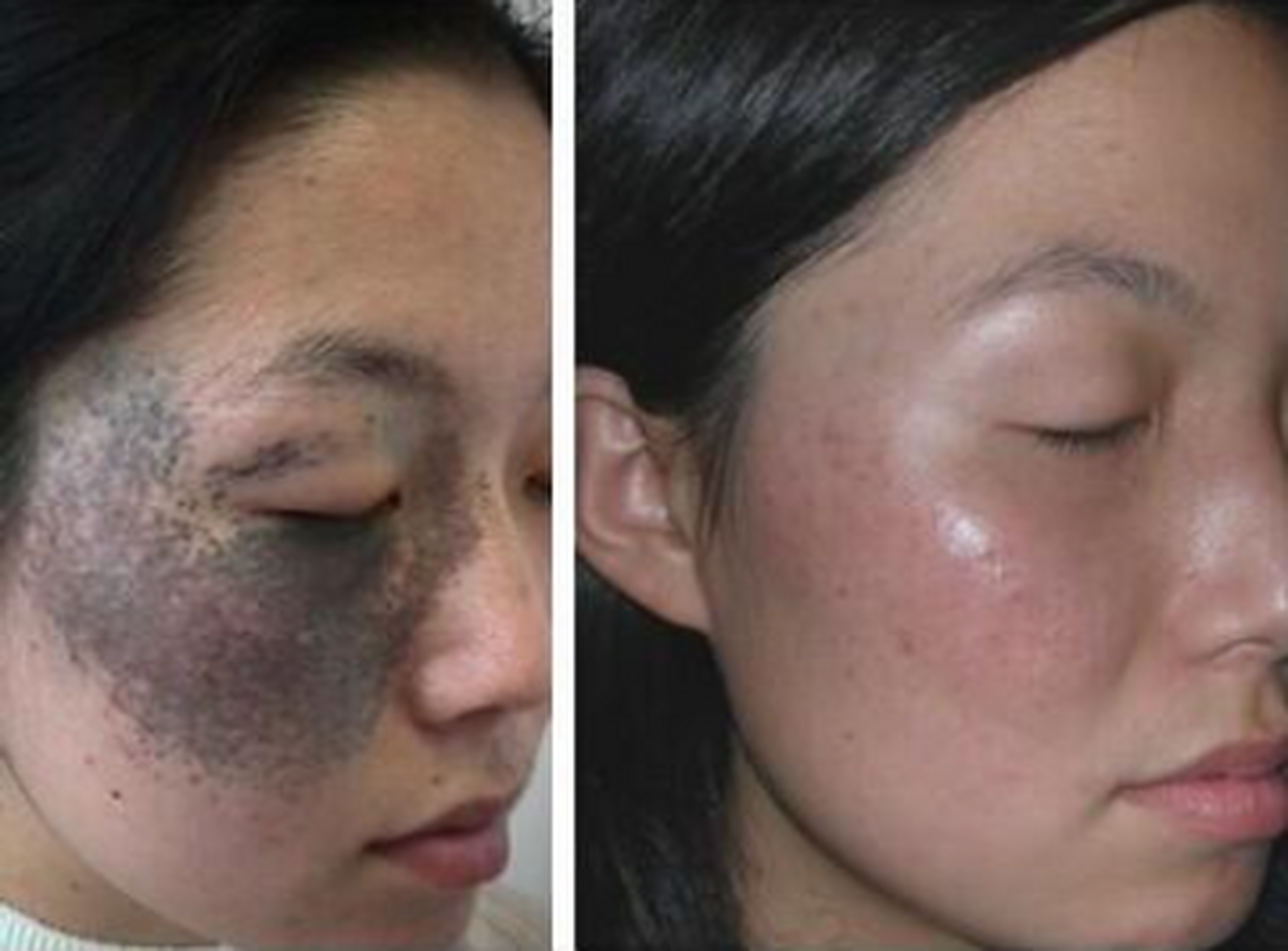 太田痣多发于单侧面部的上下眼睑,颧骨,颞部,它会随着时间不断扩散