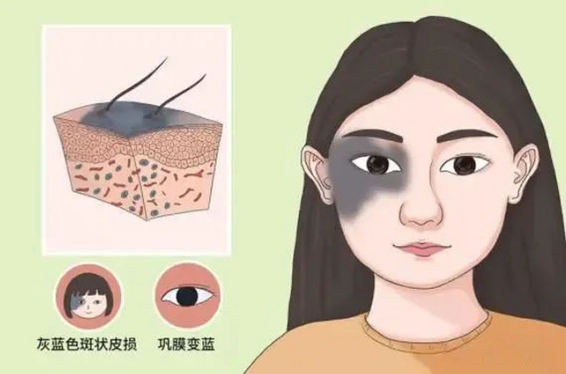 太田痣多发于单侧面部的上下眼睑,颧骨,颞部,它会随着时间不断扩散