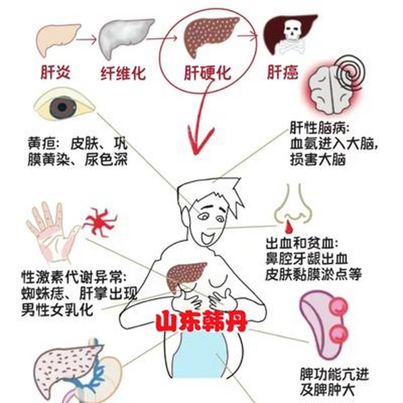 肝硬化发病机制图图片