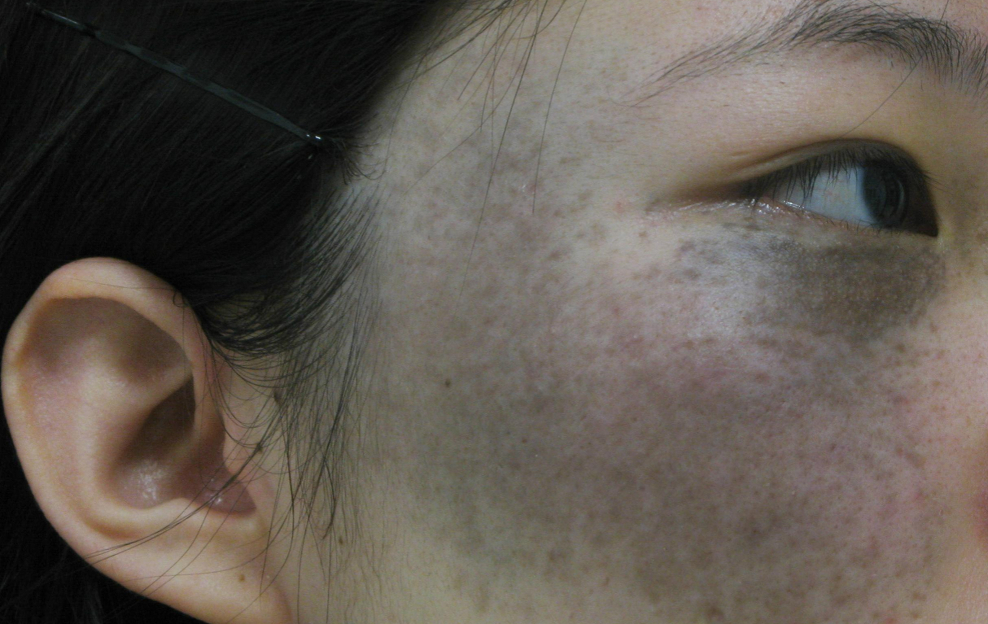 太田痣多发于单侧面部的上下眼睑,颧骨,颞部,它会随着时间不断扩散