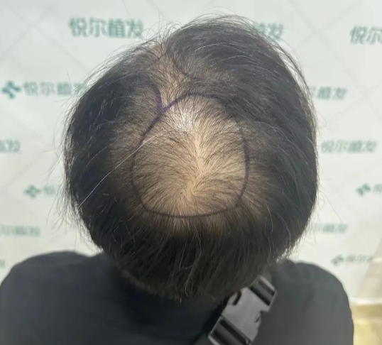 秃顶植发加养发要多少钱(秃顶植发加养发要多少钱呢)