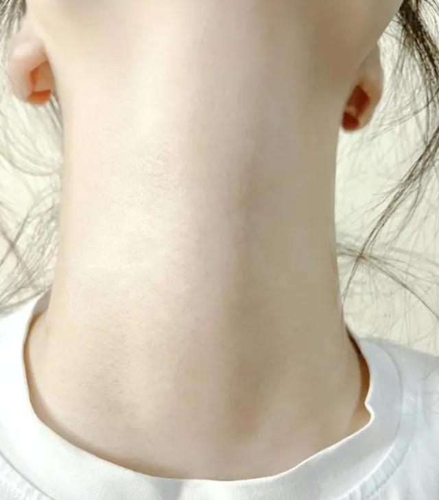 女生脖子上出现三道杠,这是带着什么呢?女生要趁早知道了