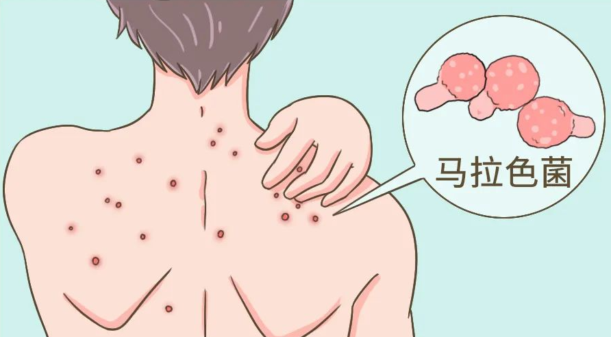 马拉色菌毛囊炎:病因,症状与防治策略