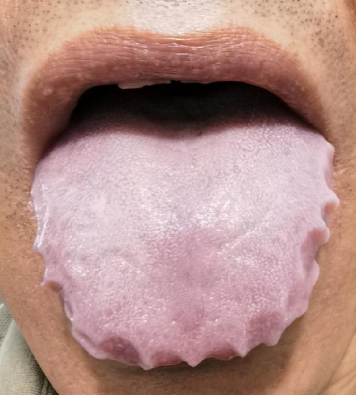 舌根——淡白,水滑,肾阳不足  舌边——齿痕,脾阳虚寒湿重  舌质