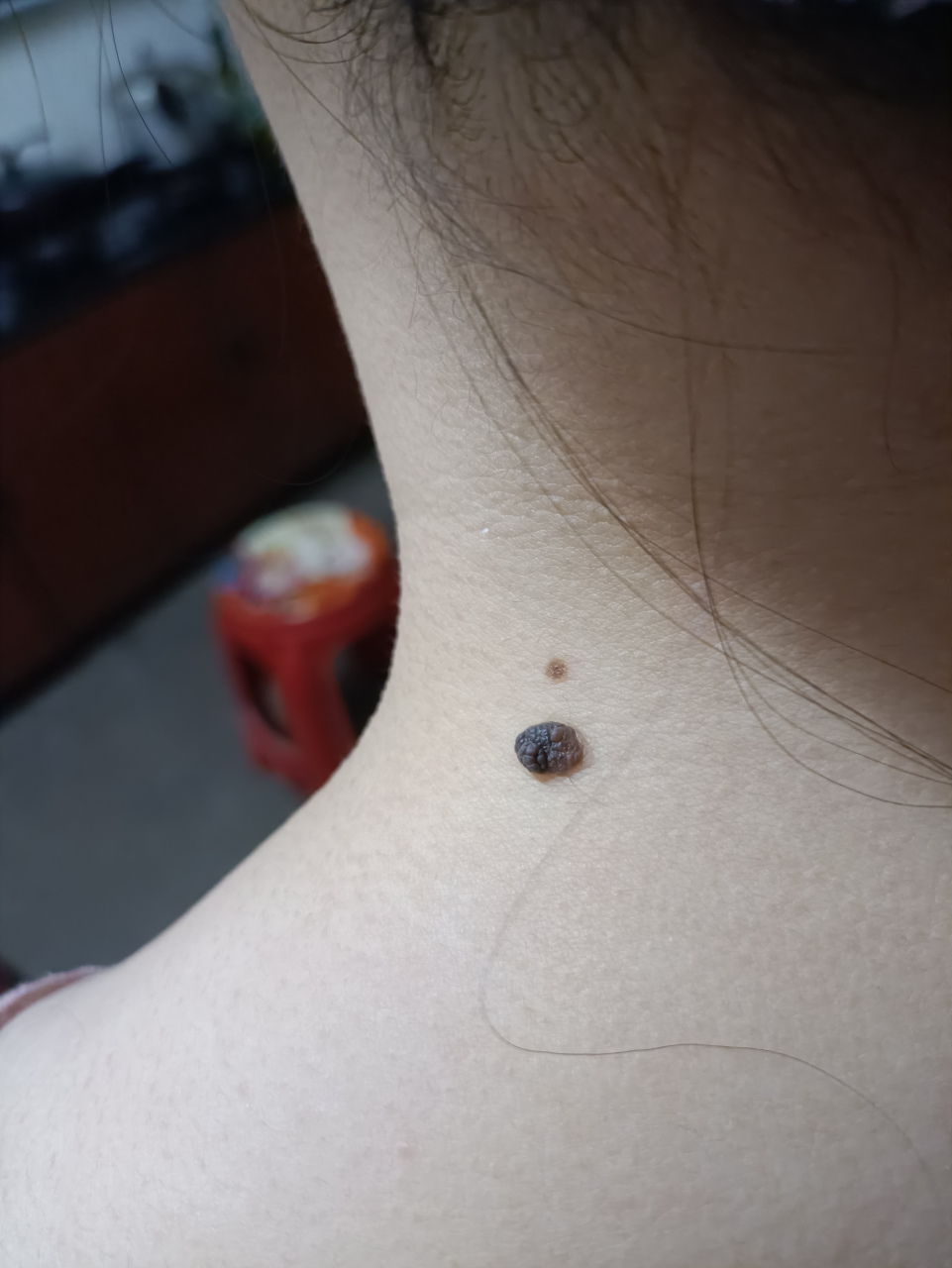 不知道这颗痣能不能做激光去除