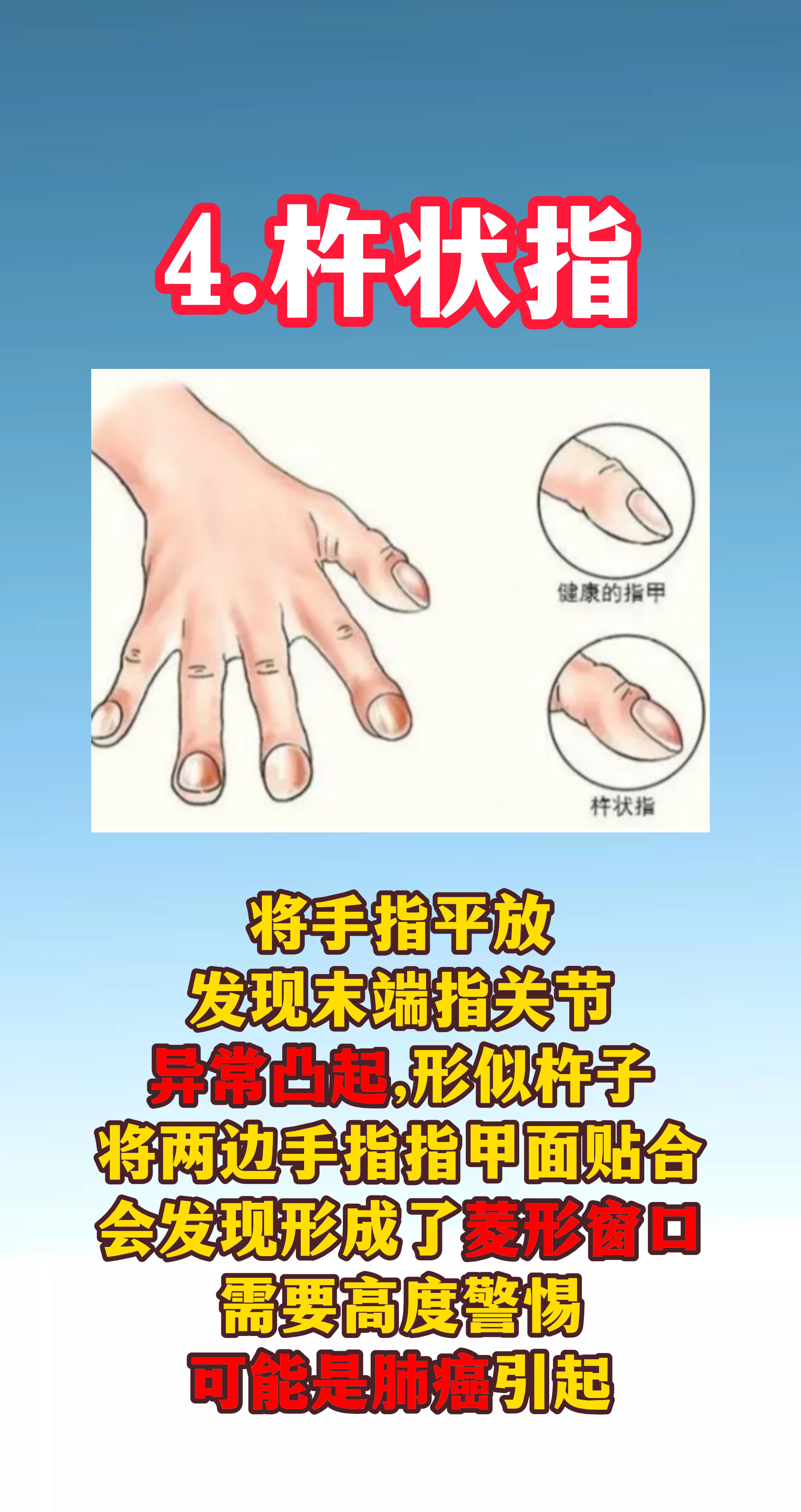 肺癌多数是拖出来的,4个症状早发现能救命