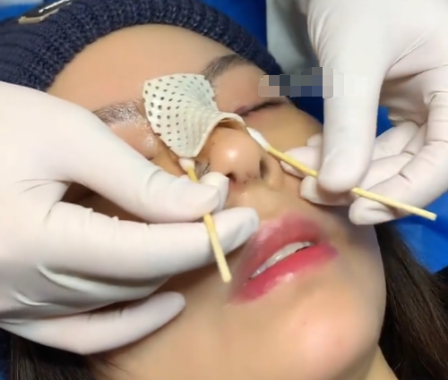 可以用别人的肋软骨做鼻子吗?肋骨鼻有什么魅力呢?来看看吧