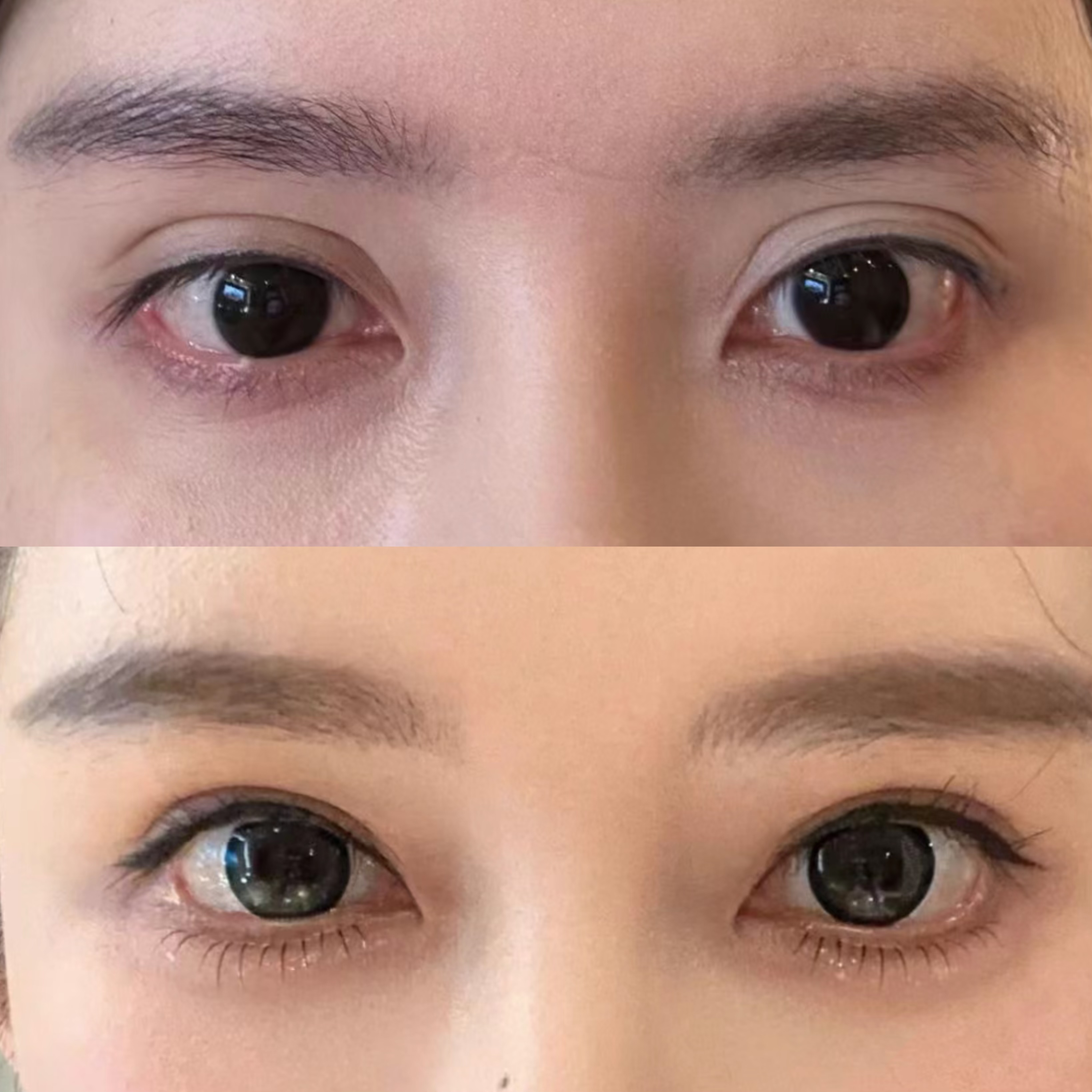 三年二修,宽改窄11mm的大宽双眼皮