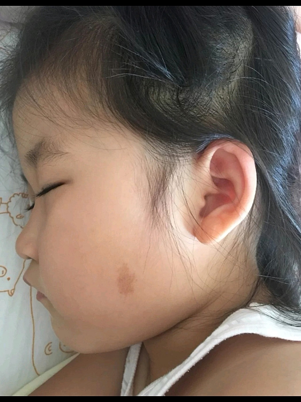 小孩脸上长咖啡斑怎么消除?