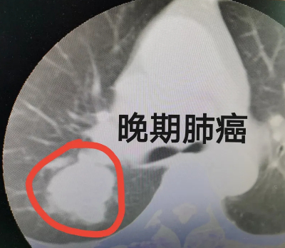 肺癌颈椎转移图片图片