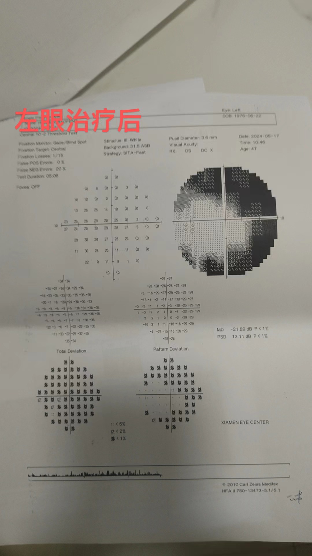 视野图右眼图片