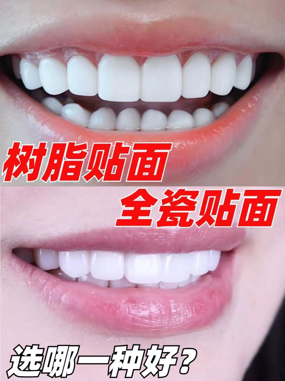 [火焰]树脂贴面or全瓷贴面有什么区别?哪种好? .