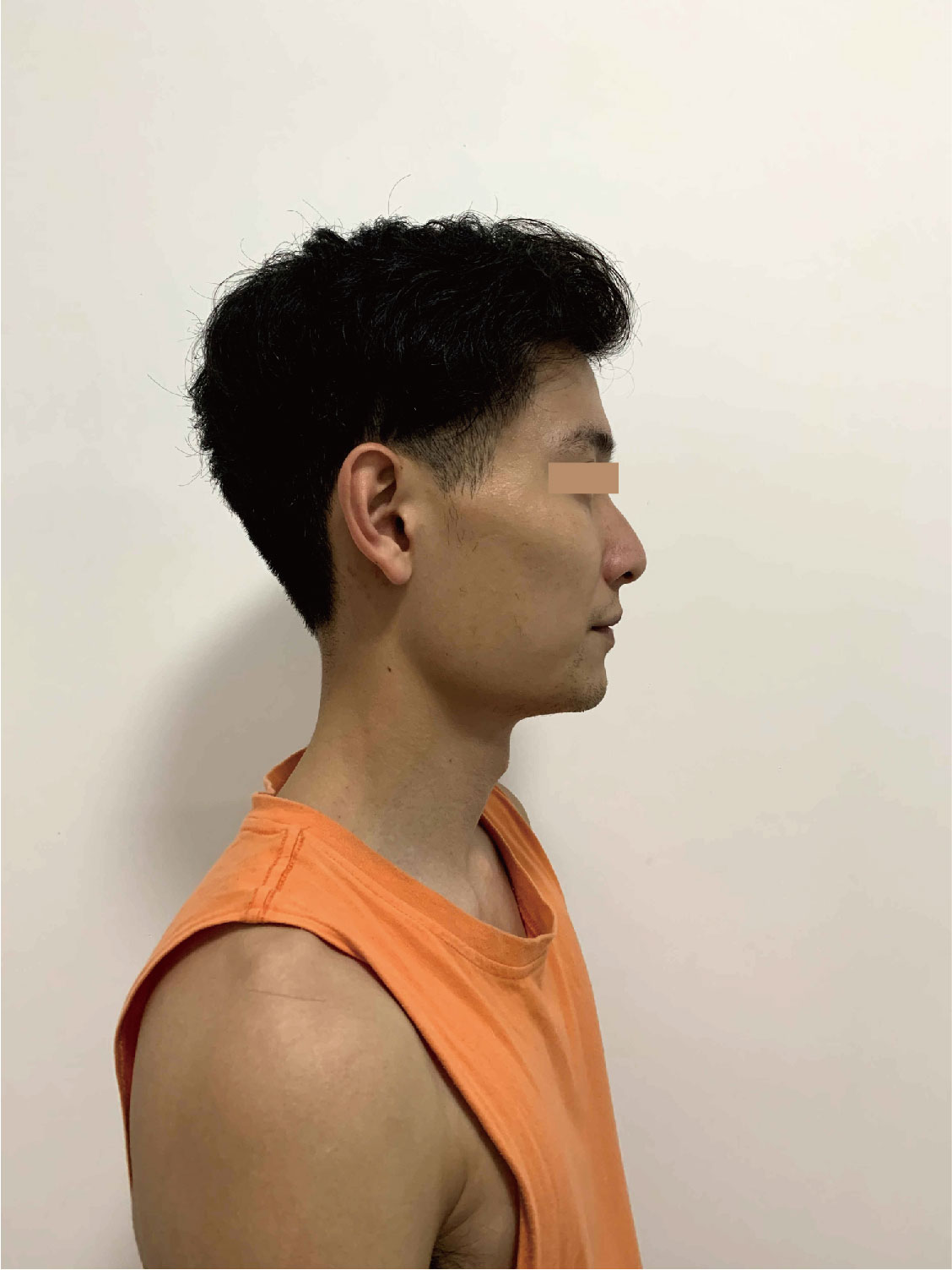 30岁颧骨颧弓很突出,比同龄人都显老