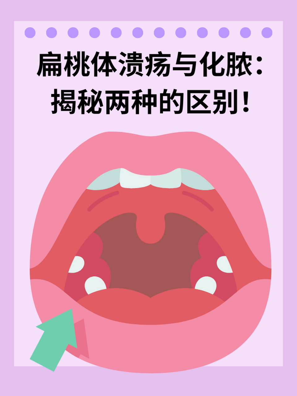 扁桃腺炎症图片