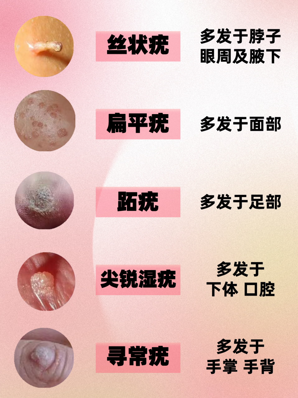 感染hpv后身体长出的5种疣分别是啥样子?无论男女千万别轻视!  1.