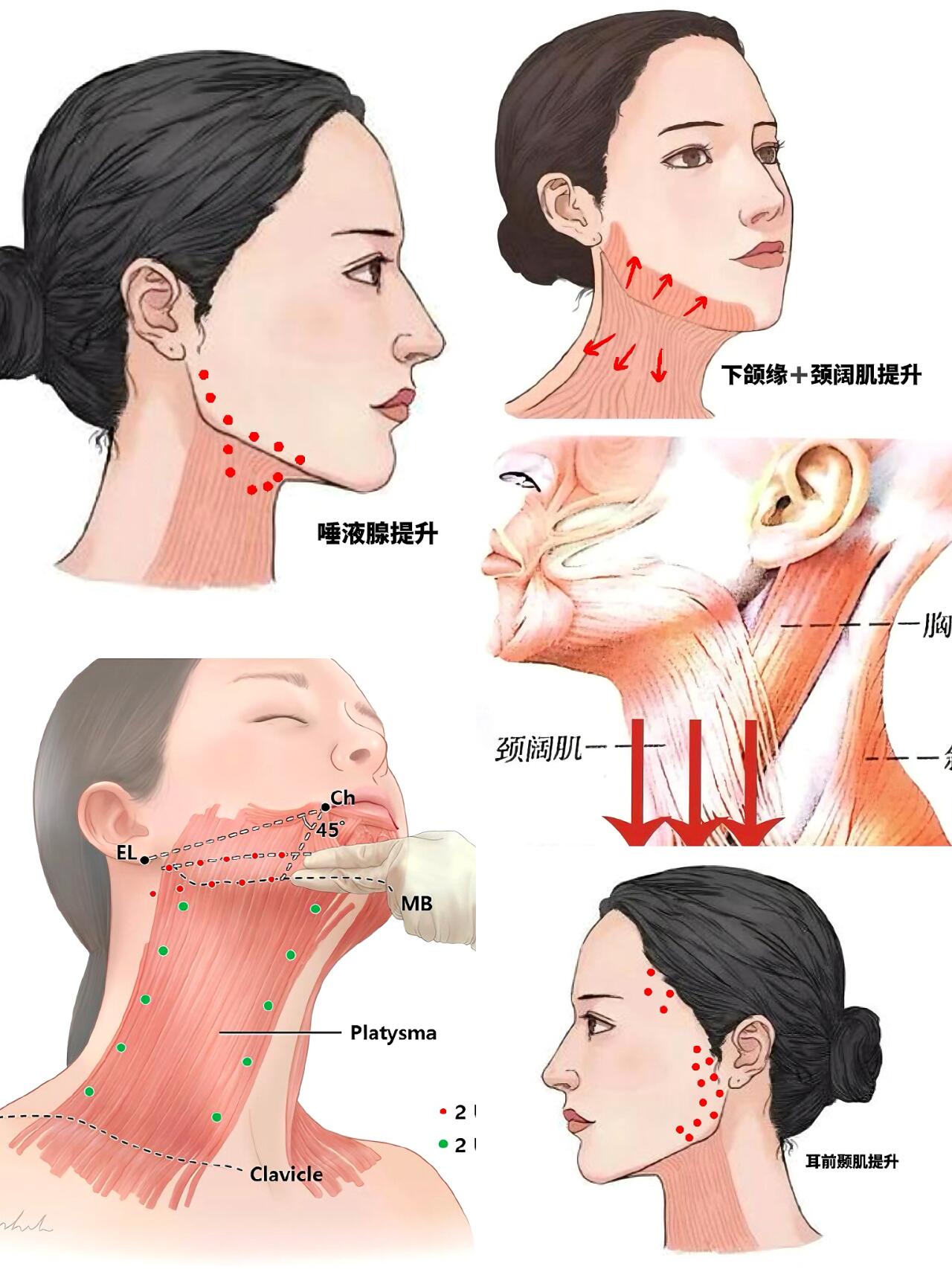 颈阔肌提升注射方法图片