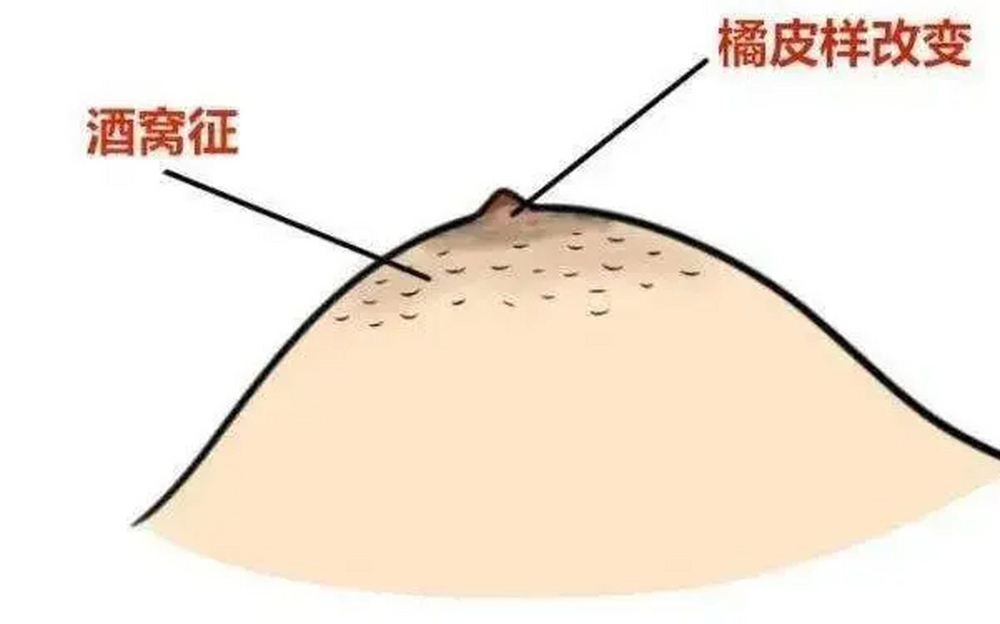 乳房酒窝是什么样子图片