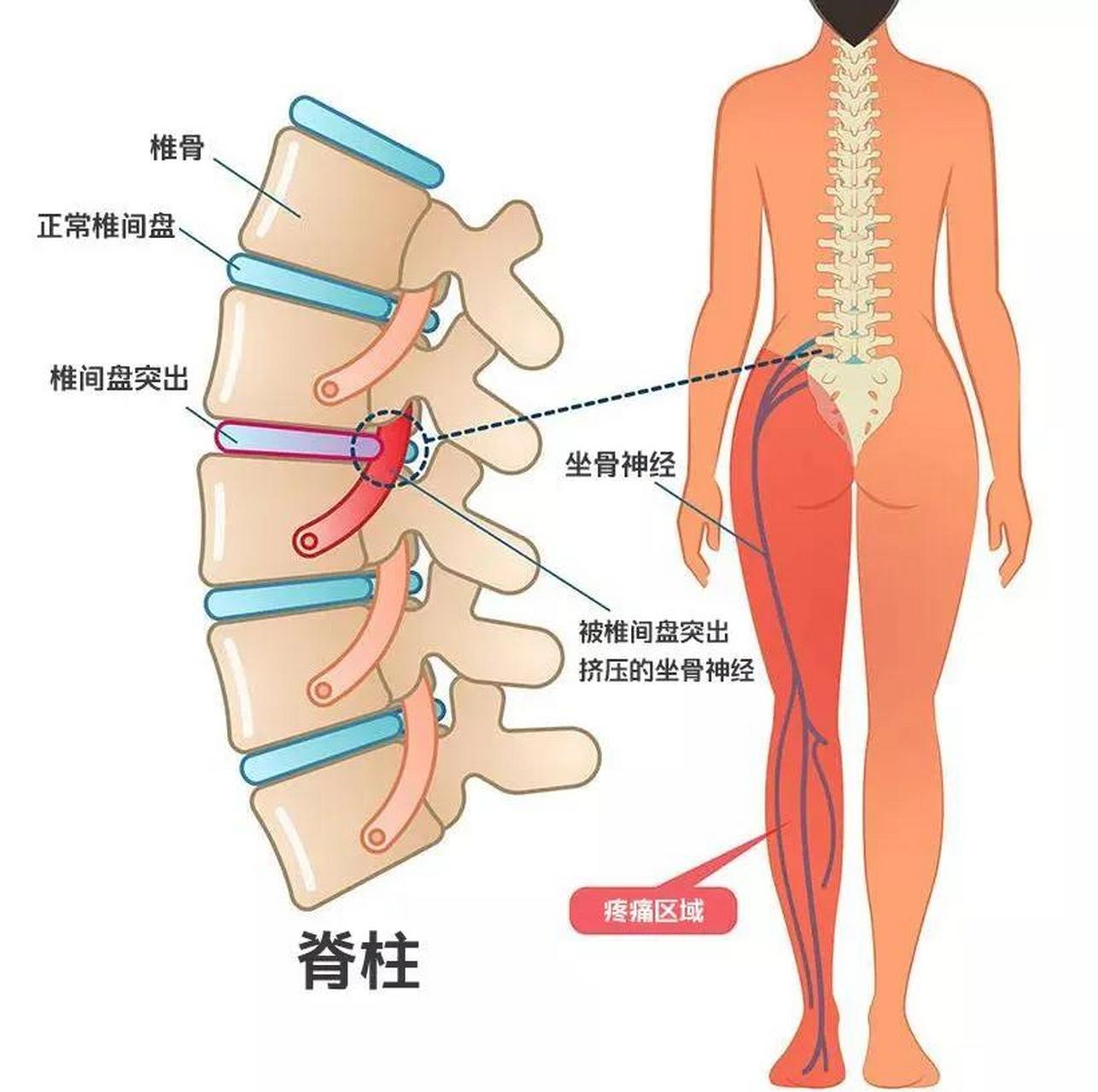 腰椎间盘位置图图片