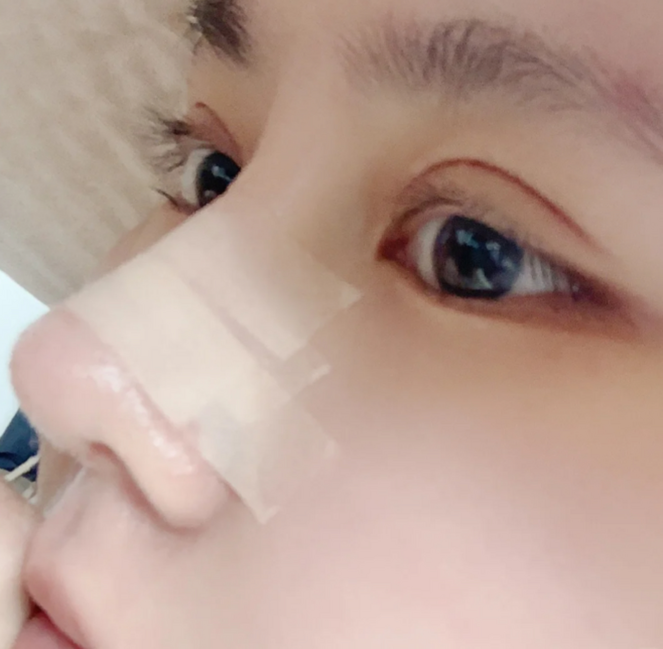 鼻综合术后为什么一定要贴胶布?