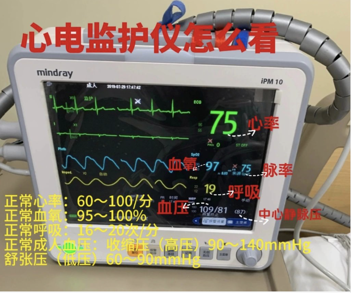 心电监护仪怎么看(实习实用篇) 个人感觉心电监护仪这块的内容真的蛮