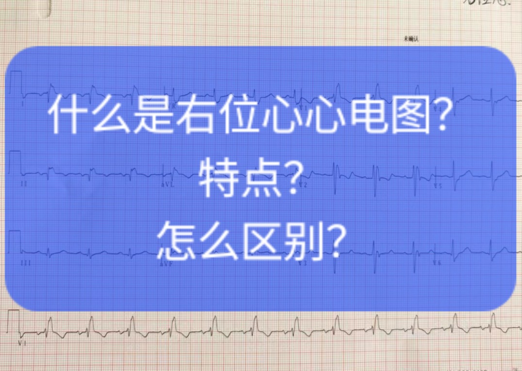什么是右位心心电图?特点?怎么区别?