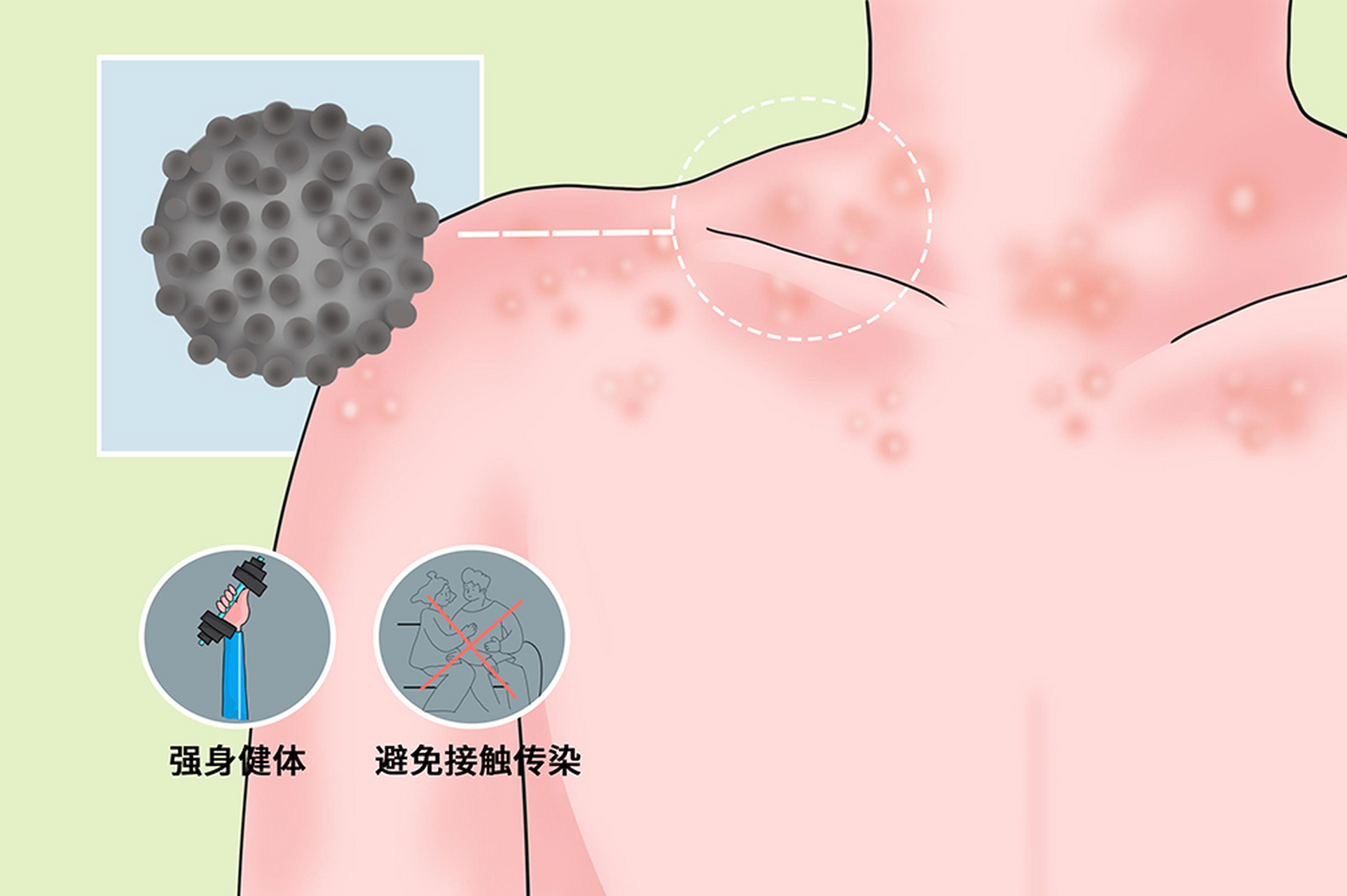 单纯疱疹和带状疱疹的区别