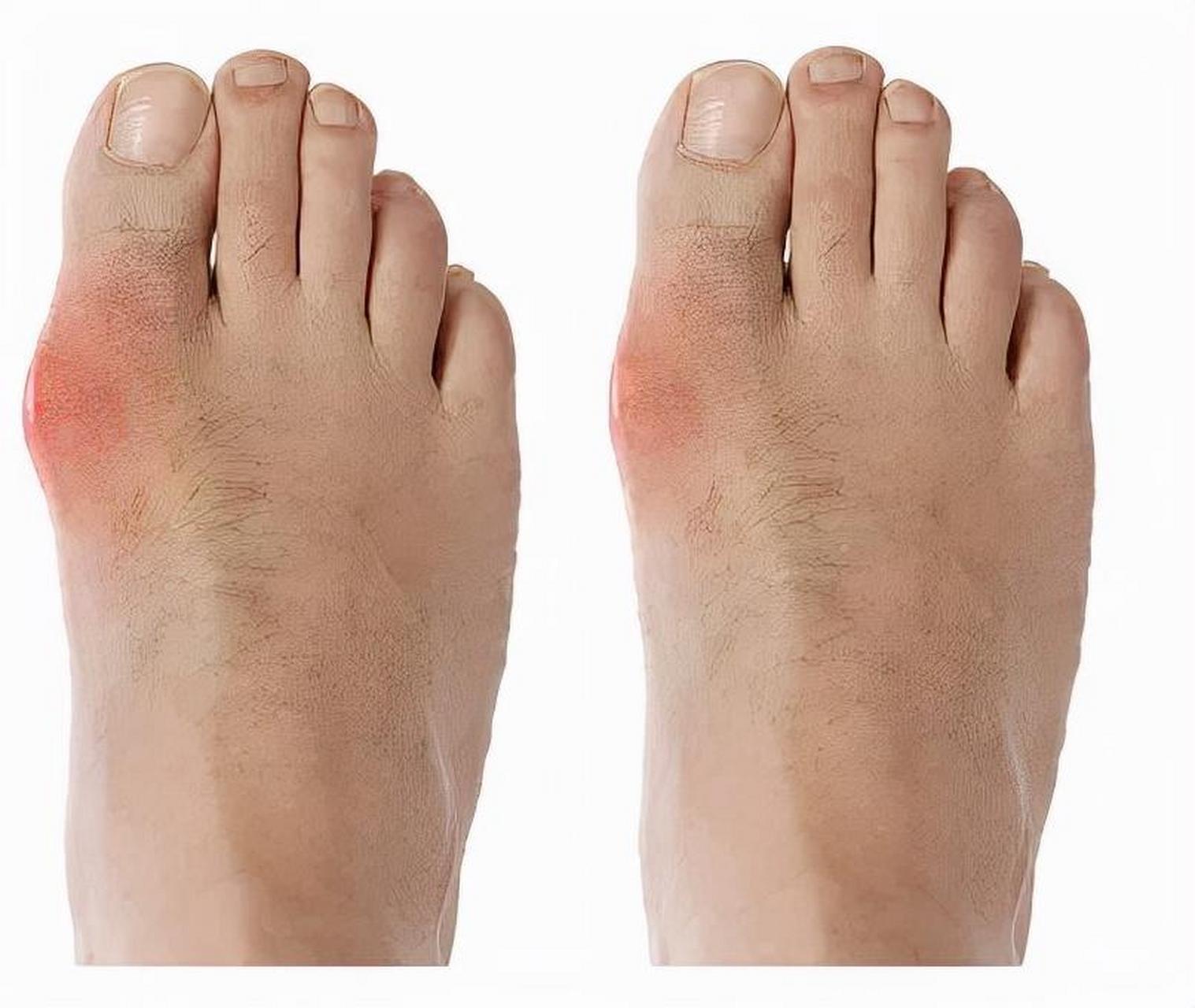 最常受累的往往是足部第一跖趾关节,也可见于踝关节,膝关节和掌指关节