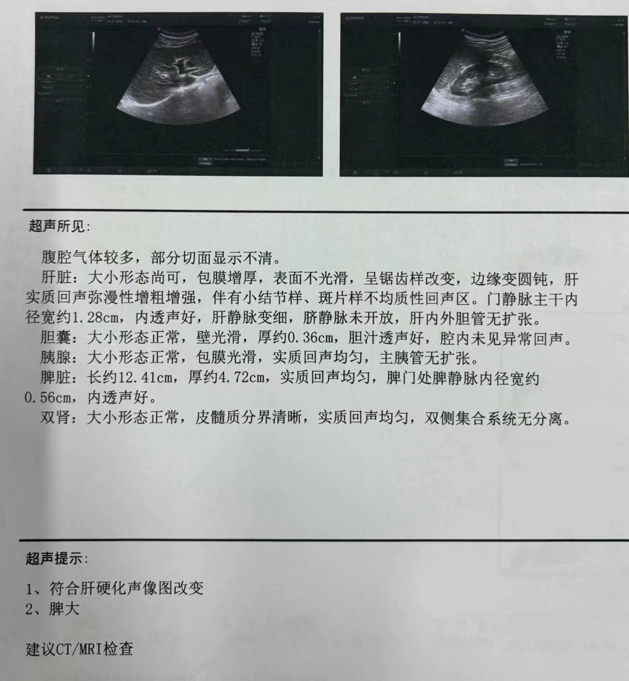 3cm是门静脉高压 5肝占位可能是肝血管瘤肝占位肝癌乙