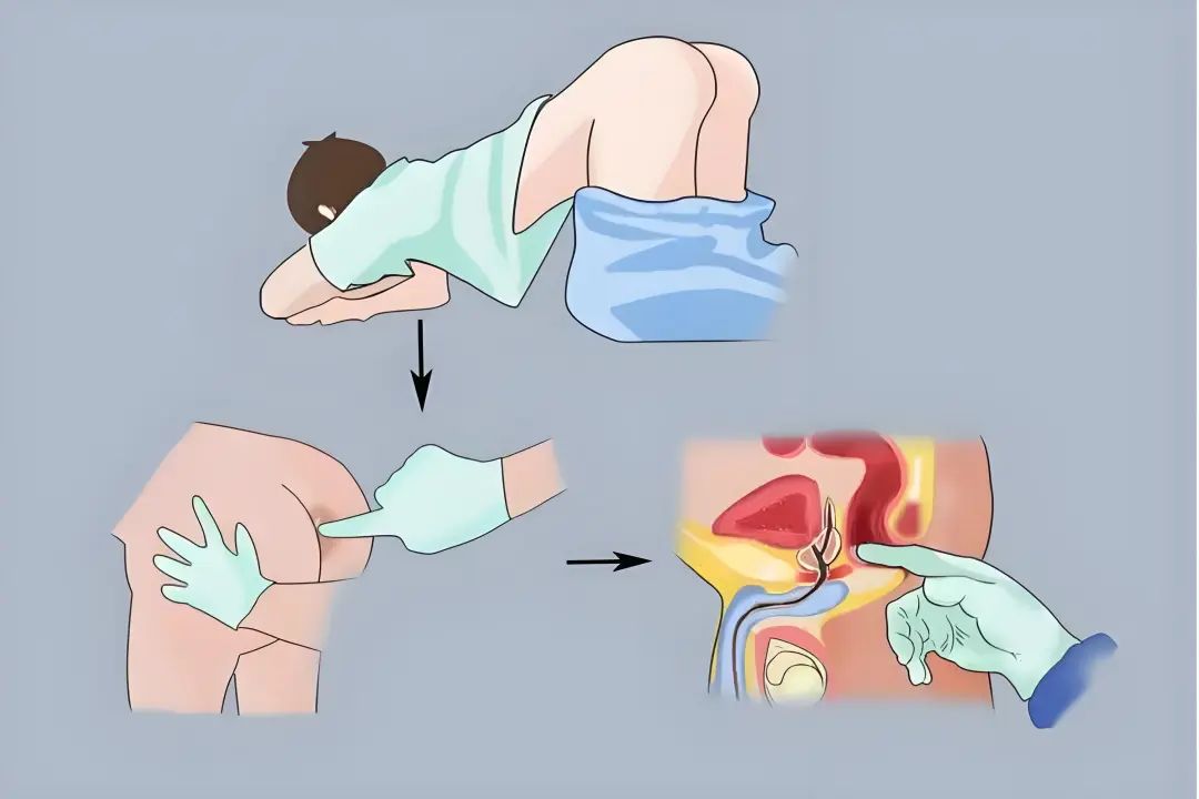 医生取前列腺液太疼了图片