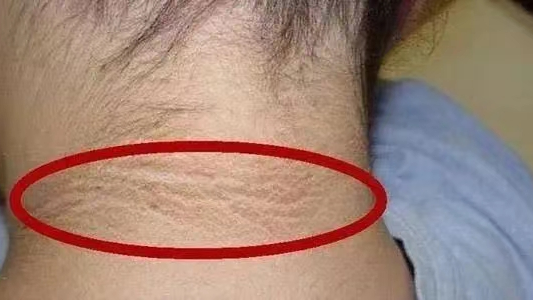 脖子上的"黑褶子"总是洗不干净,这究竟是什么?