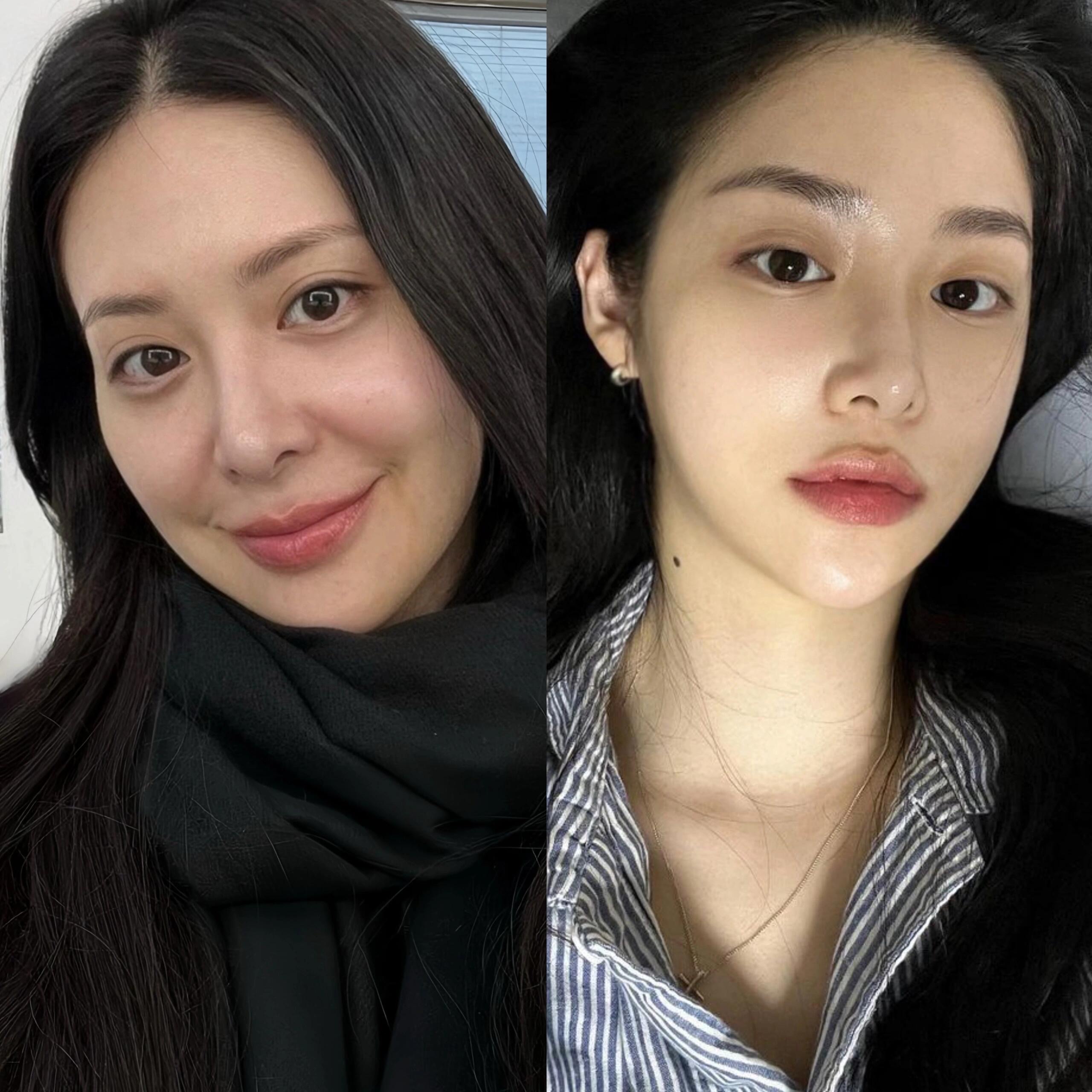 最近去做了无痕筋膜提升配合一点注射