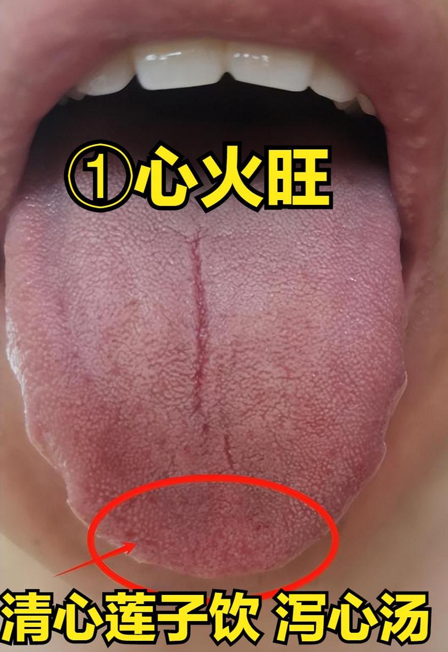 ①心火旺 症状:老是烦躁不安,老是失眠,经常口腔溃疡,口干舌燥,心悸