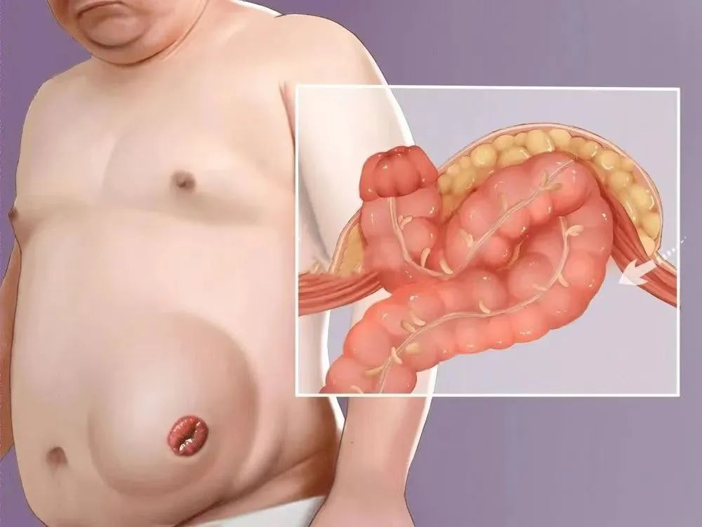 造口旁疝大如球 微创手术解烦忧