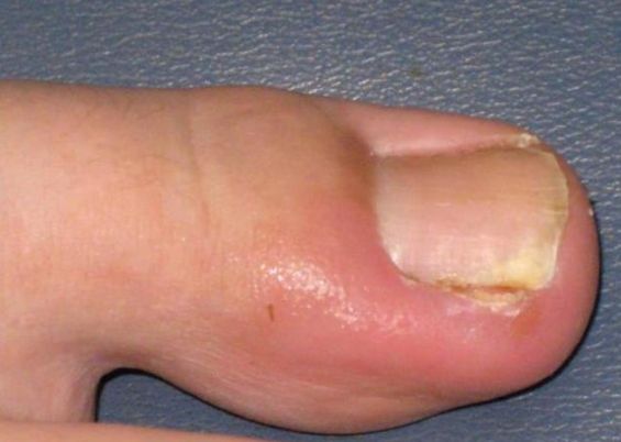 健康笔记创作营第二季#甲沟炎主要有以下几种类型及相应表现: