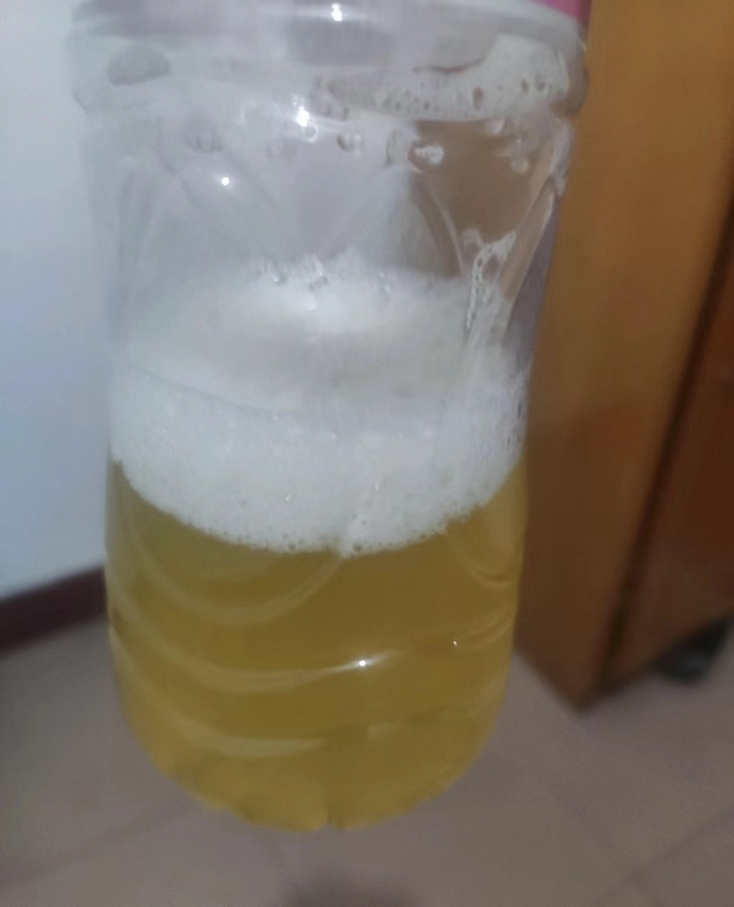 尿蛋白的出现常常是引发患者就医的导火线.