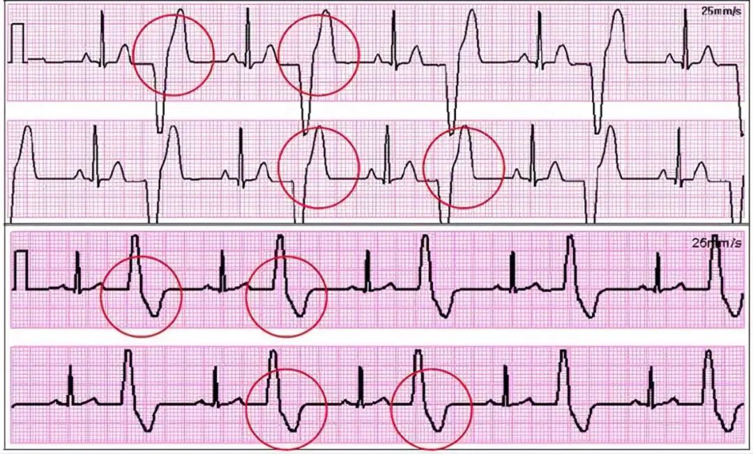 室性早搏心电图特点图片