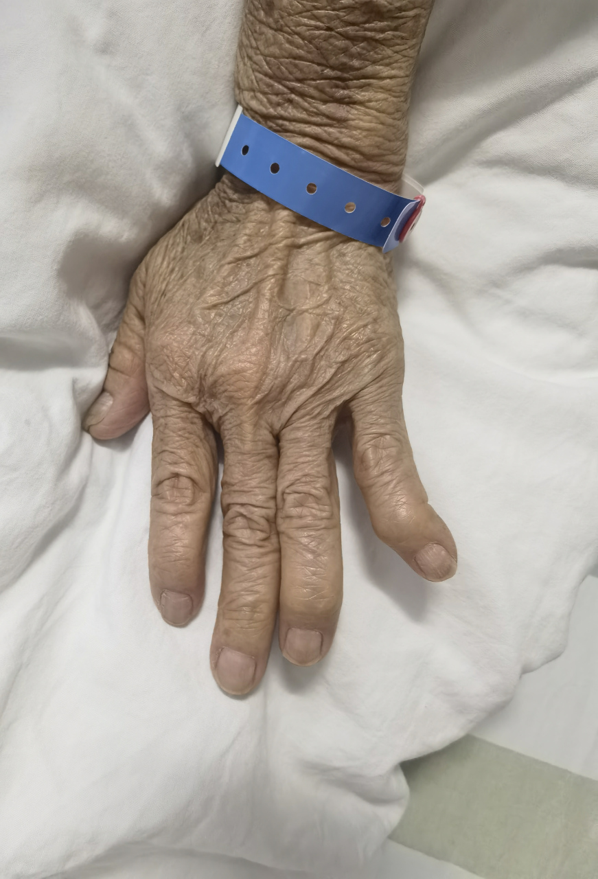 类风湿关节炎多表现为越来越严重的多关节肿胀,疼痛.