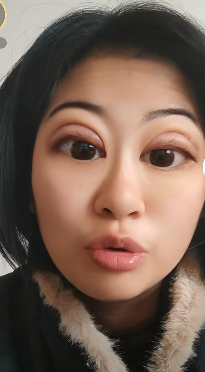 花了1万块钱做的欧式大双眼皮