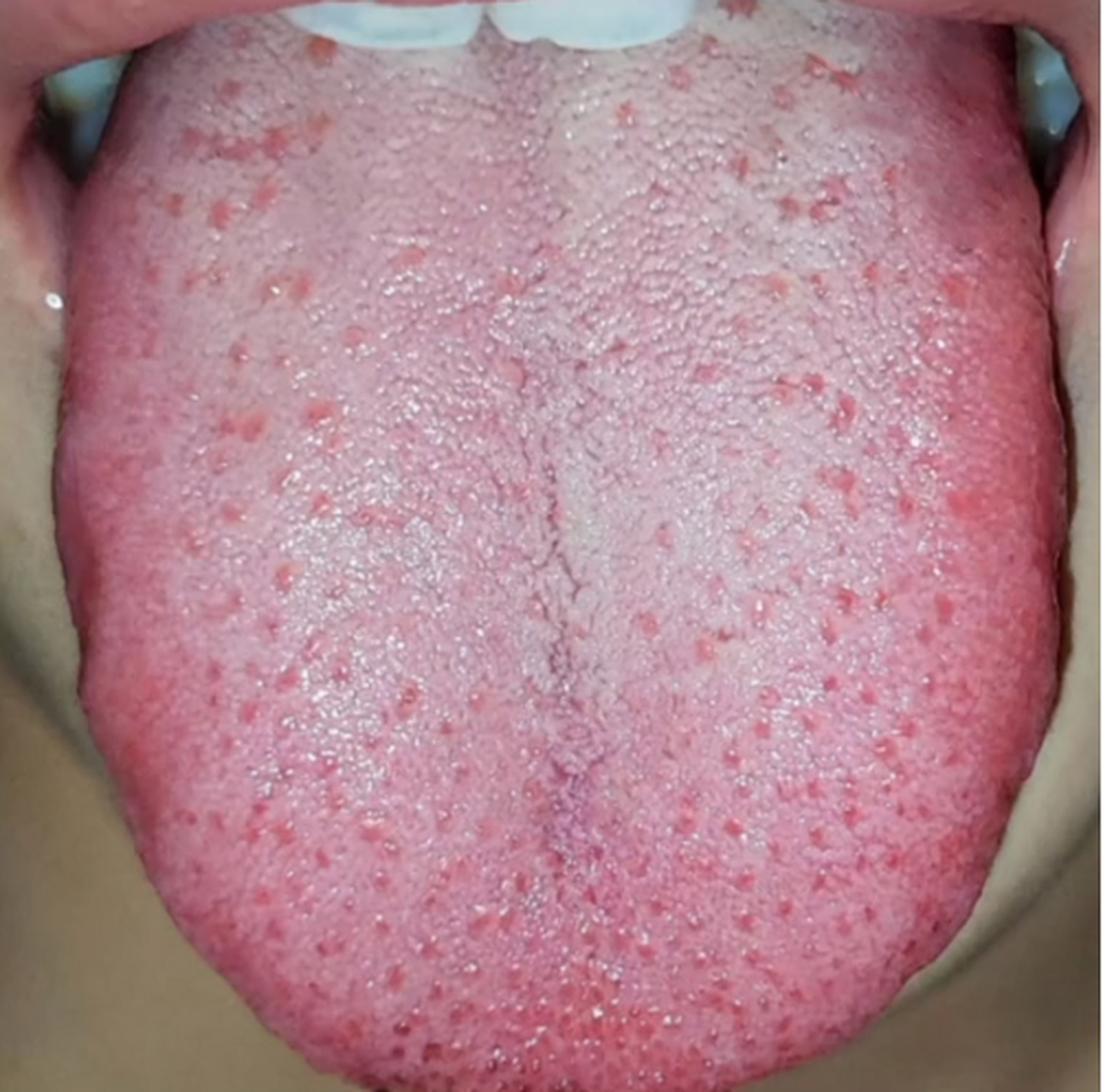 就这种舌头,不赶快调理,再拖下去难缠的血瘀可都要出来了!