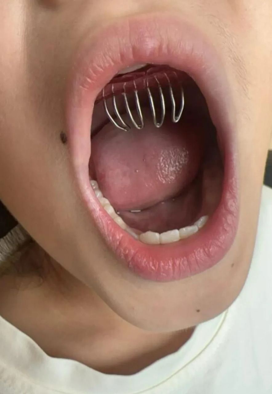 哇塞,儿童矫正地包天看着好恐怖啊,真的有效果吗?