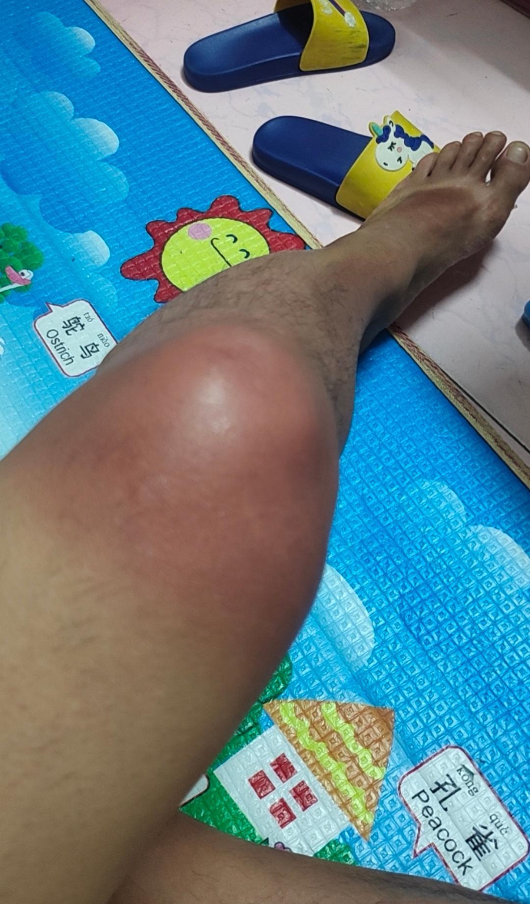 当时只顾着钓鱼,我还以为腿是被太阳给晒的,回家睡了一晚,第二天早上