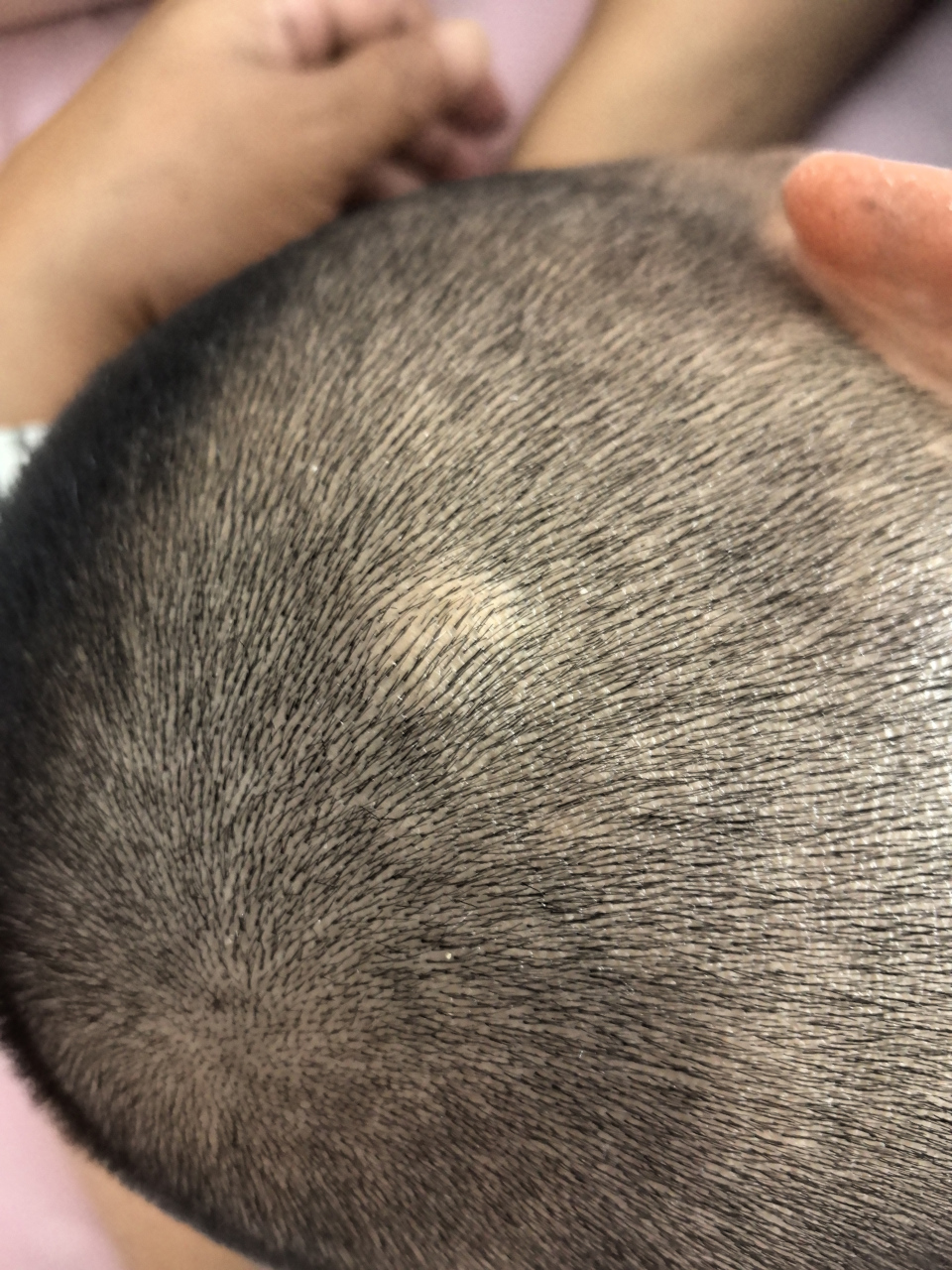 老公头上有个皮脂腺囊肿,摸上去感觉还能在皮下滑动,周边有液体.