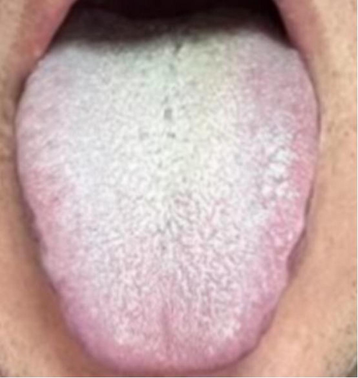 舌苔厚腻发白,确实是寒湿,但是如果你用附子理中没有用,说明疾病已经