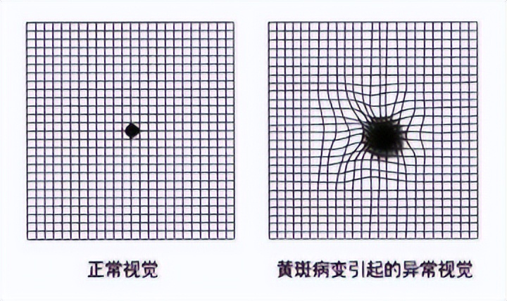 视网膜病变看东西视物变形自测视物变形图片视物扭曲黄斑病变看东西是