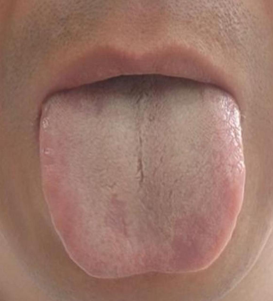 舌中间一条裂纹,你还以为是脾肾阳虚,可就麻烦大了  这位患者的病情